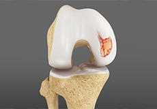  Articular Cartilage (Surface) Injury