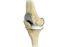 Total Knee Joint Replacement