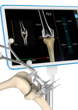 Computer Assisted Surgery