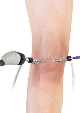 Knee Arthroscopy