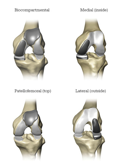 Mako Robotic Arm Assisted partial knee replacement