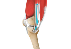 ACL Reconstruction Hamstring Tendon