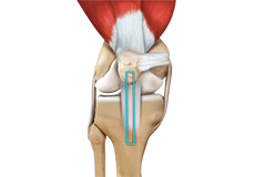 ACL Reconstruction Patellar Tendon