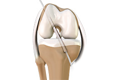 Anterior Cruciate Ligament (ACL) Reconstruction