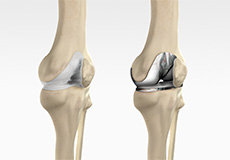 Total Knee Joint Replacement